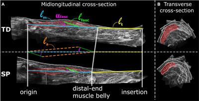 Gastrocnemius Medialis Muscle Geometry and Extensibility in Typically Developing Children and Children With Spastic Paresis Aged 6–13 Years
